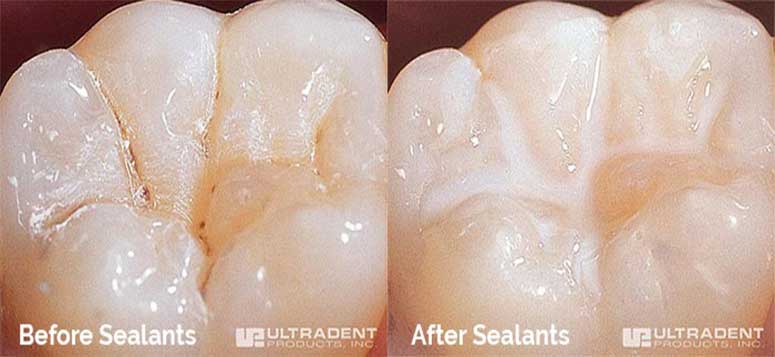 tooth before and after sealants