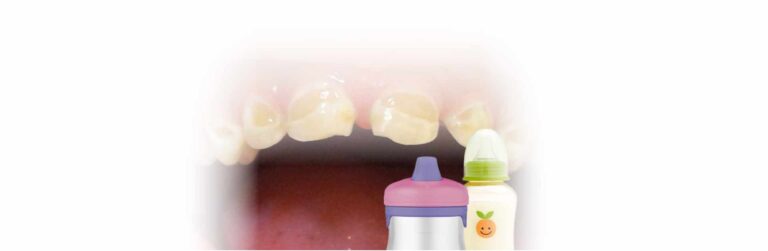 Baby Bottle Tooth Decay