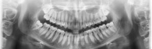 why a panoramic x-ray