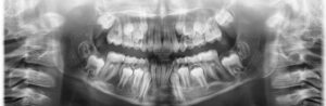 why a panoramic x-ray