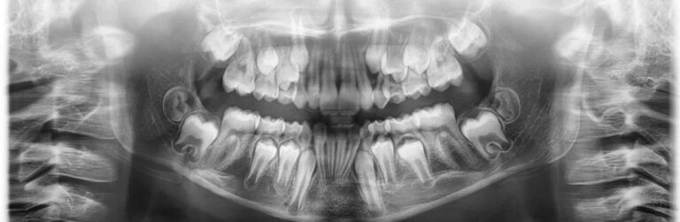 why a panoramic x-ray