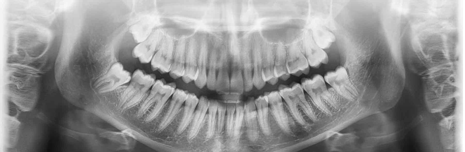 why a panoramic x-ray